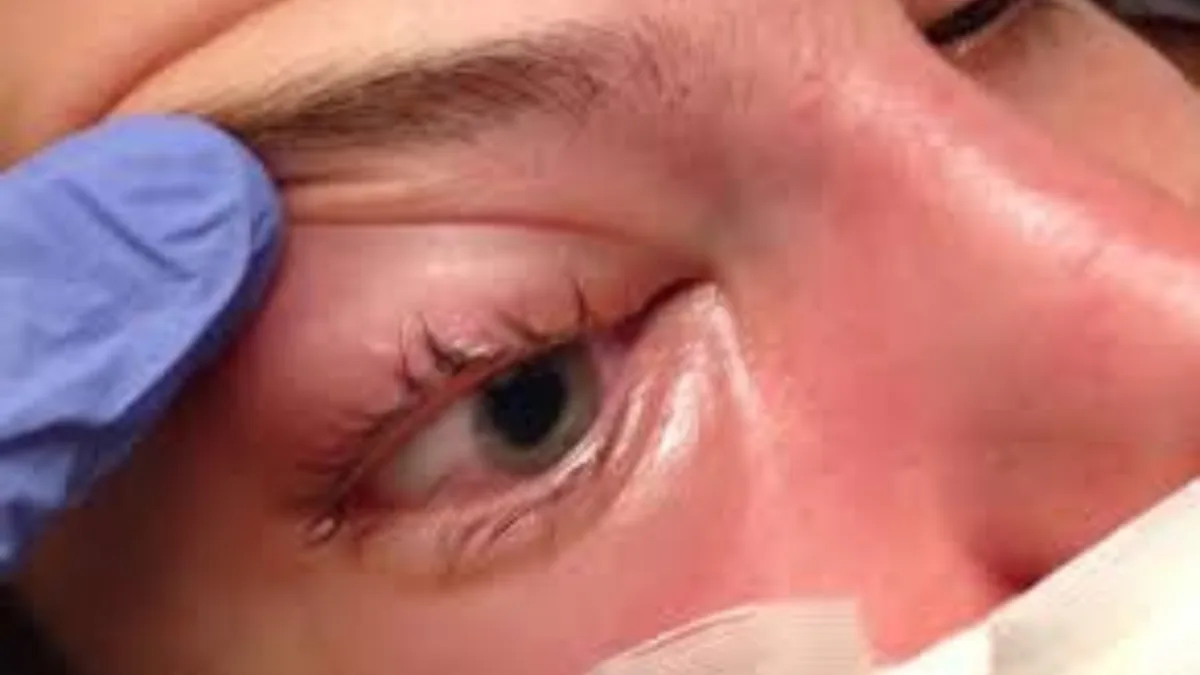 Mucormycosis